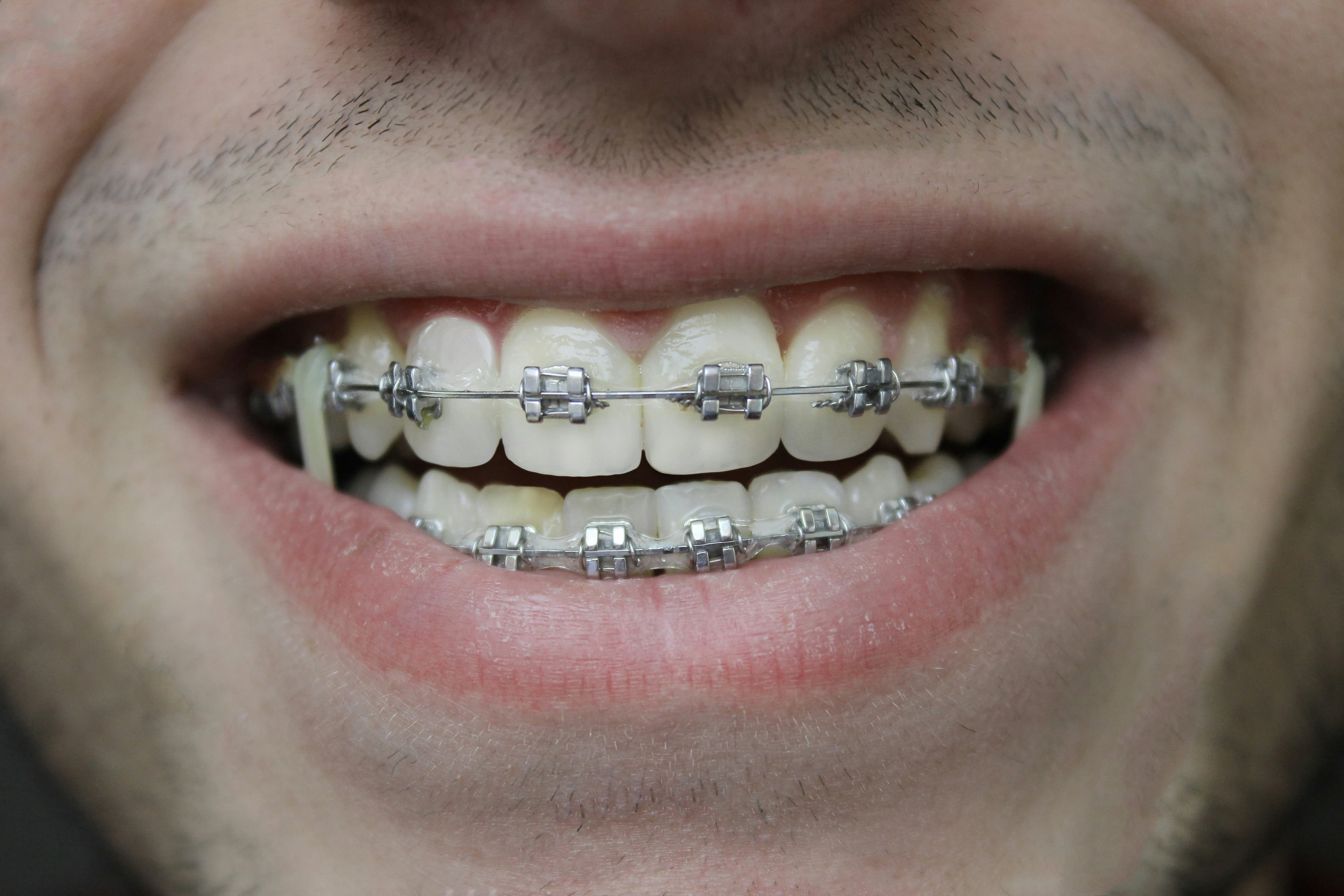 Brackets estéticos