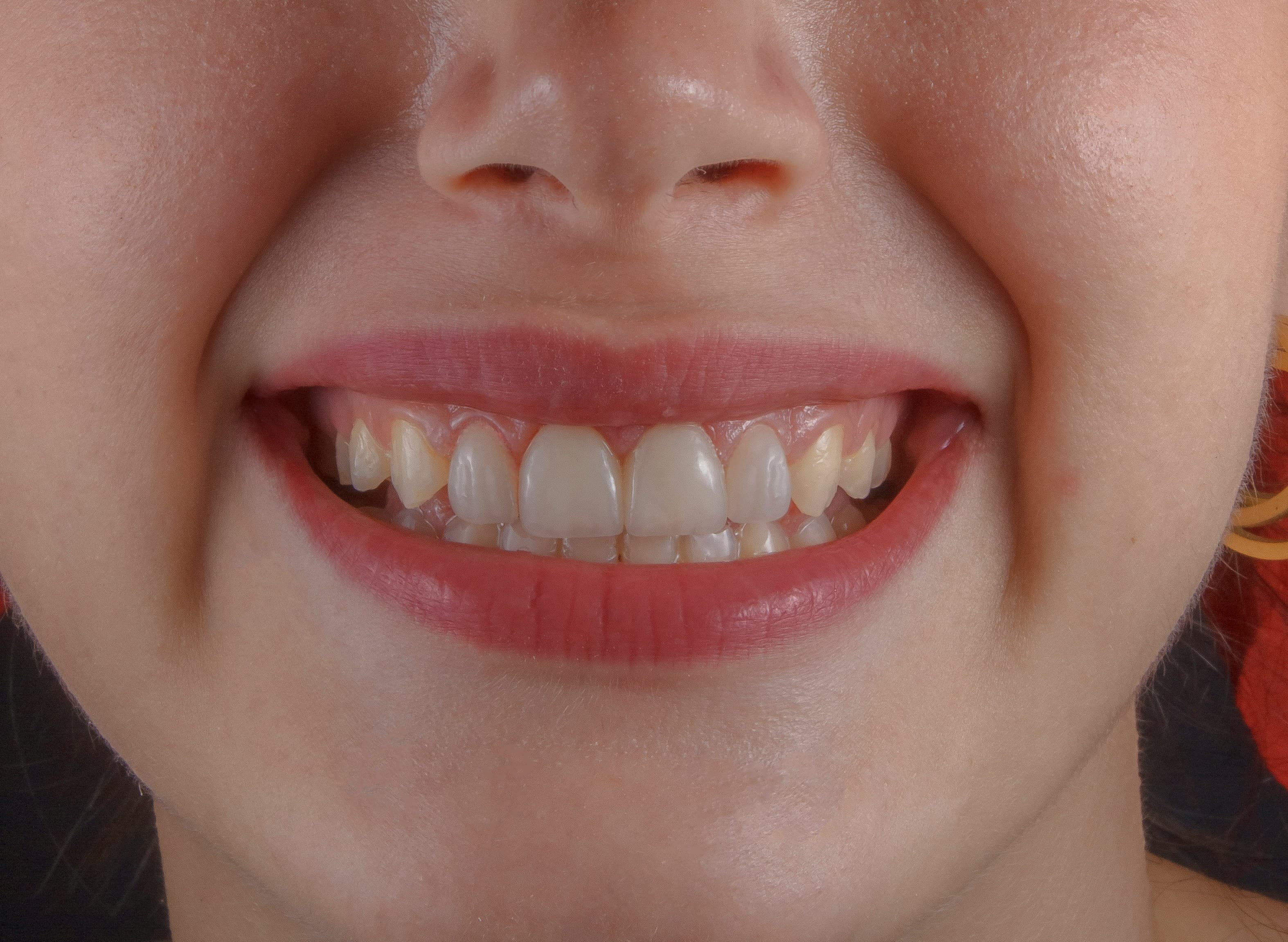 Sonrisa final