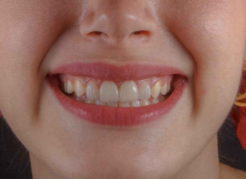 Sonrisa final